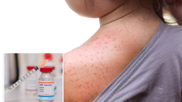 ny-declares-state-disaster-emergency-over-measles-outbreak-in-rural-communities