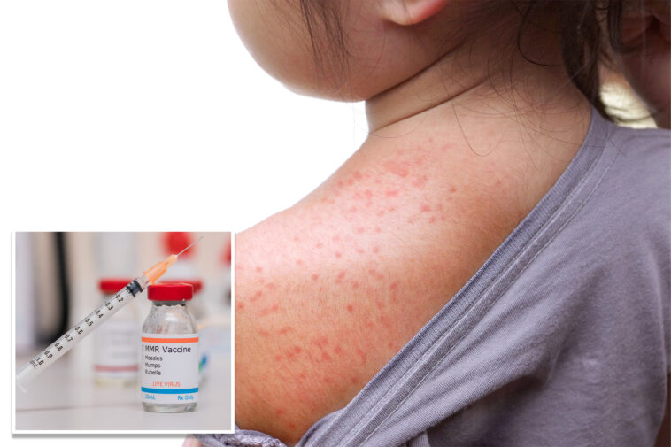 ny-declares-state-disaster-emergency-over-measles-outbreak-in-rural-communities