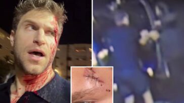 ‘pretty-little-liars’-star-keegan-allen-reveals-gruesome-injuries-after-violent-gunpoint-robbery-in-west-hollywood