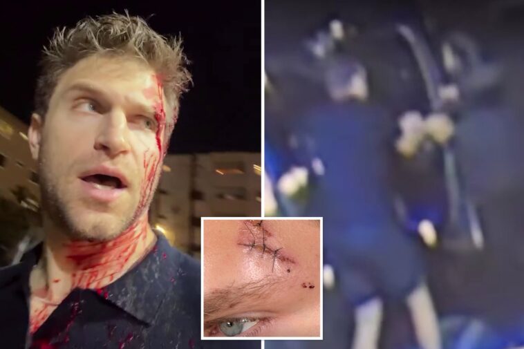 ‘pretty-little-liars’-star-keegan-allen-reveals-gruesome-injuries-after-violent-gunpoint-robbery-in-west-hollywood