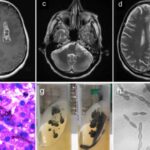 deadly,-brain-liquifying-fungus-is-on-the-rise-in-the-us-—-and-scientists-don’t-know-why