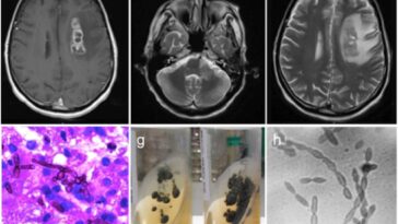 deadly,-brain-liquifying-fungus-is-on-the-rise-in-the-us-—-and-scientists-don’t-know-why