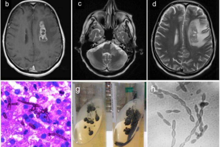 deadly,-brain-liquifying-fungus-is-on-the-rise-in-the-us-—-and-scientists-don’t-know-why