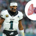what-is-pulmonary-embolism?-the-serious-blood-clot-condition-sidelining-jalen-hurts